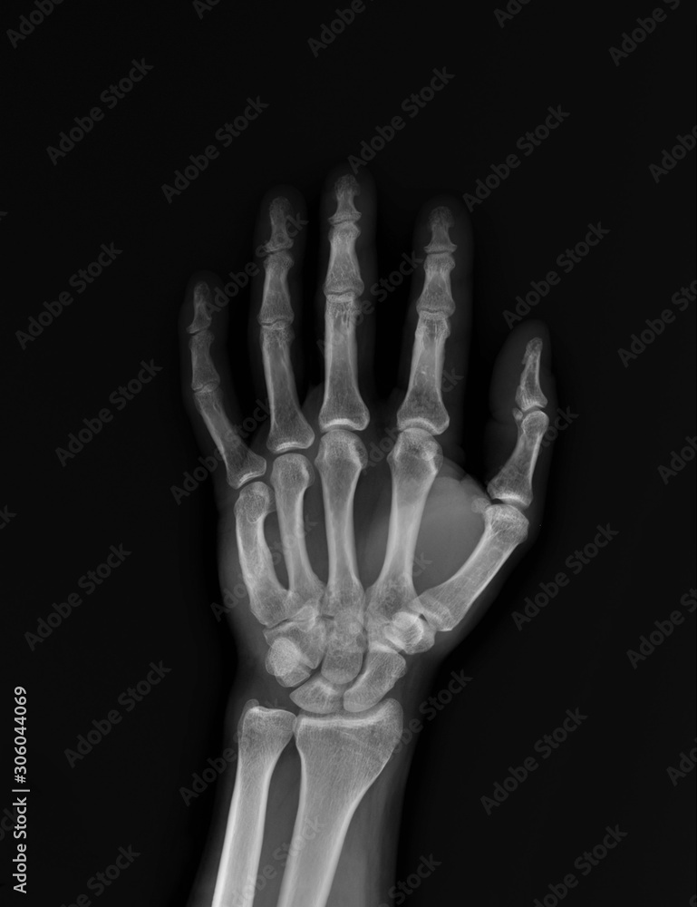 normal x-ray of the hand bones and fingers,orthopedics, medical diagnostics, rheumatology normal x-ray of the hand bones and fingers,orthopedics, medical diagnostics, rheumatology