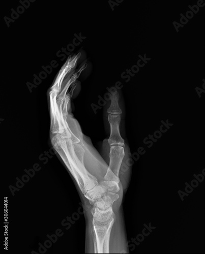 normal x-ray of the hand bones and fingers,orthopedics, medical diagnostics, rheumatology