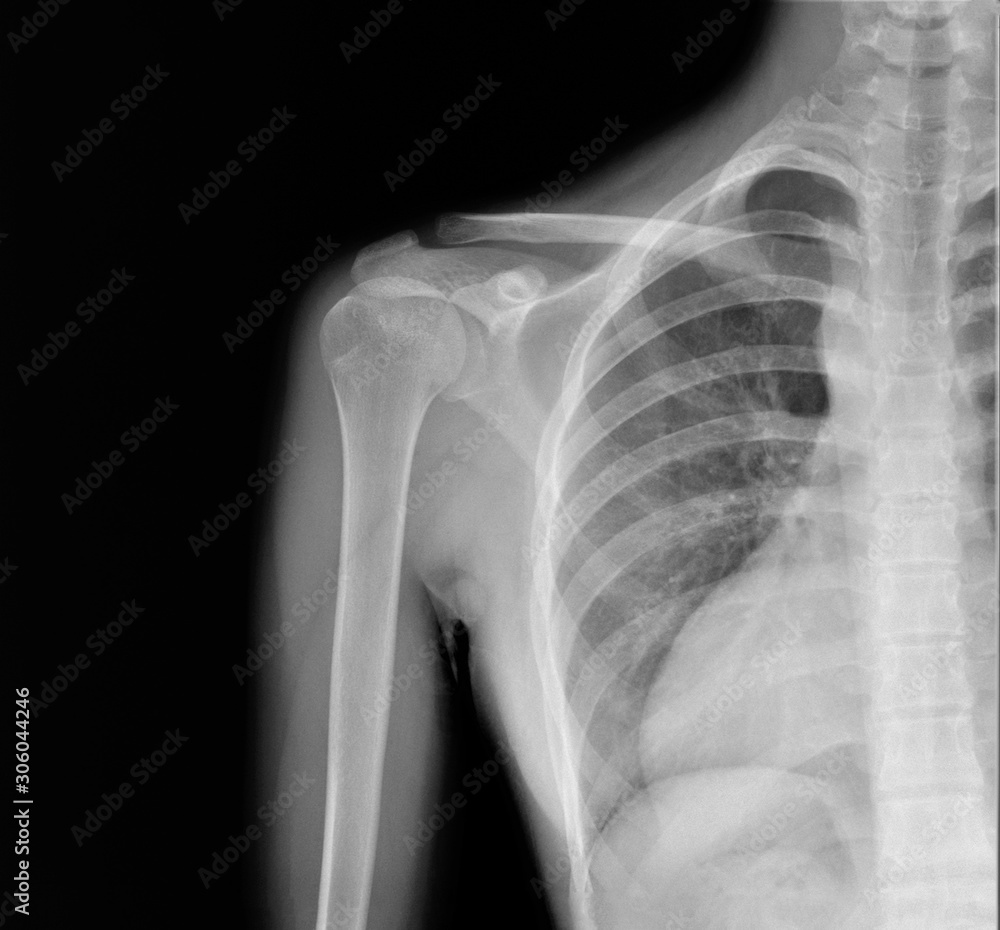 normal radiography of the shoulder joint in direct projection, traumatology and orthopedics, traumatology, sports injury normal radiography of the shoulder joint in direct projection, traumatology and orthopedics, traumatology, sports injury
