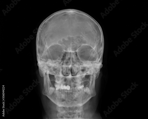 normal x-ray of the skull in direct projection, medical diagnostics, traumatology and orthopedics, neurosurgery