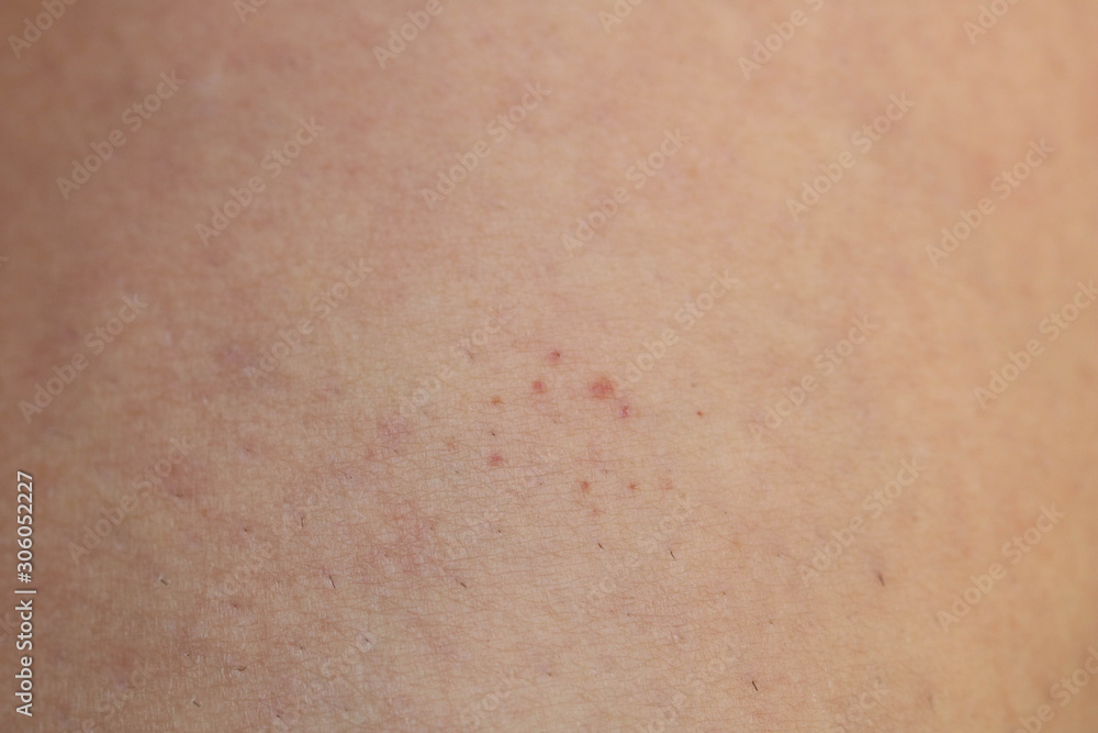 Leg showing Capillaritis due to Leaking Capillary Blood Vessels also