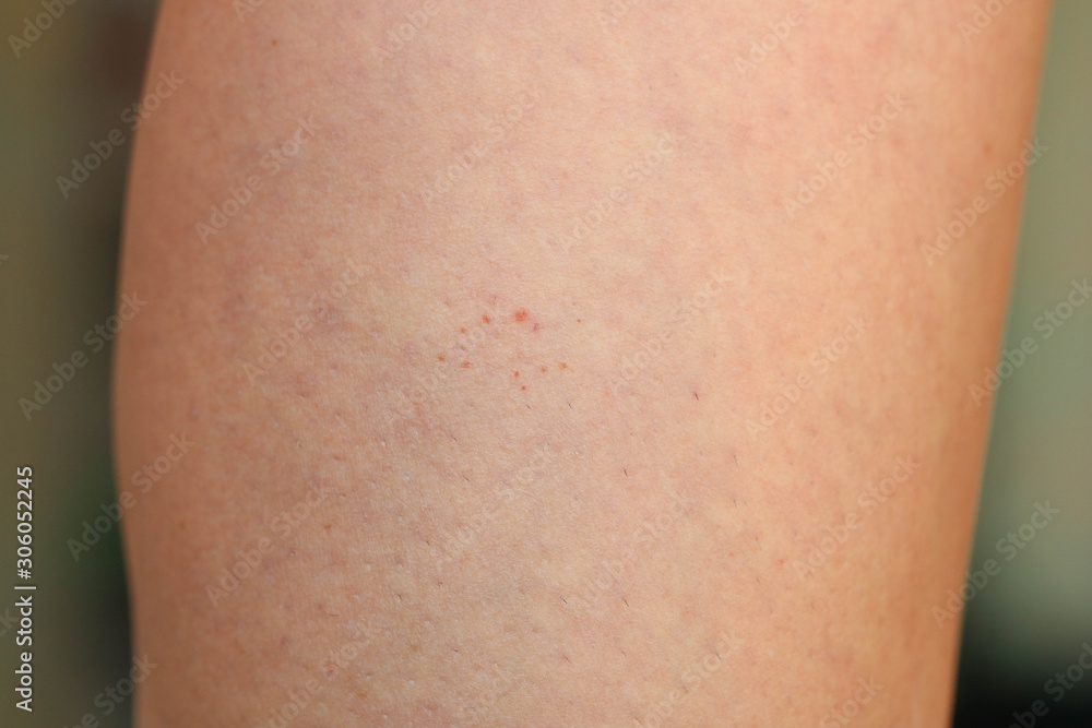 Leg showing Capillaritis due to Leaking Capillary Blood Vessels also known as Schamberg Disease. Rust-colored spots typical of Schamberg disease. Leg showing Capillaritis due to Leaking Capillary Blood Vessels also known as Schamberg Disease. Rust-colored spots typical of Schamberg disease.