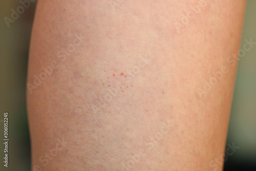 Leg showing Capillaritis due to Leaking Capillary Blood Vessels also known as Schamberg Disease. Rust-colored spots typical of Schamberg disease.