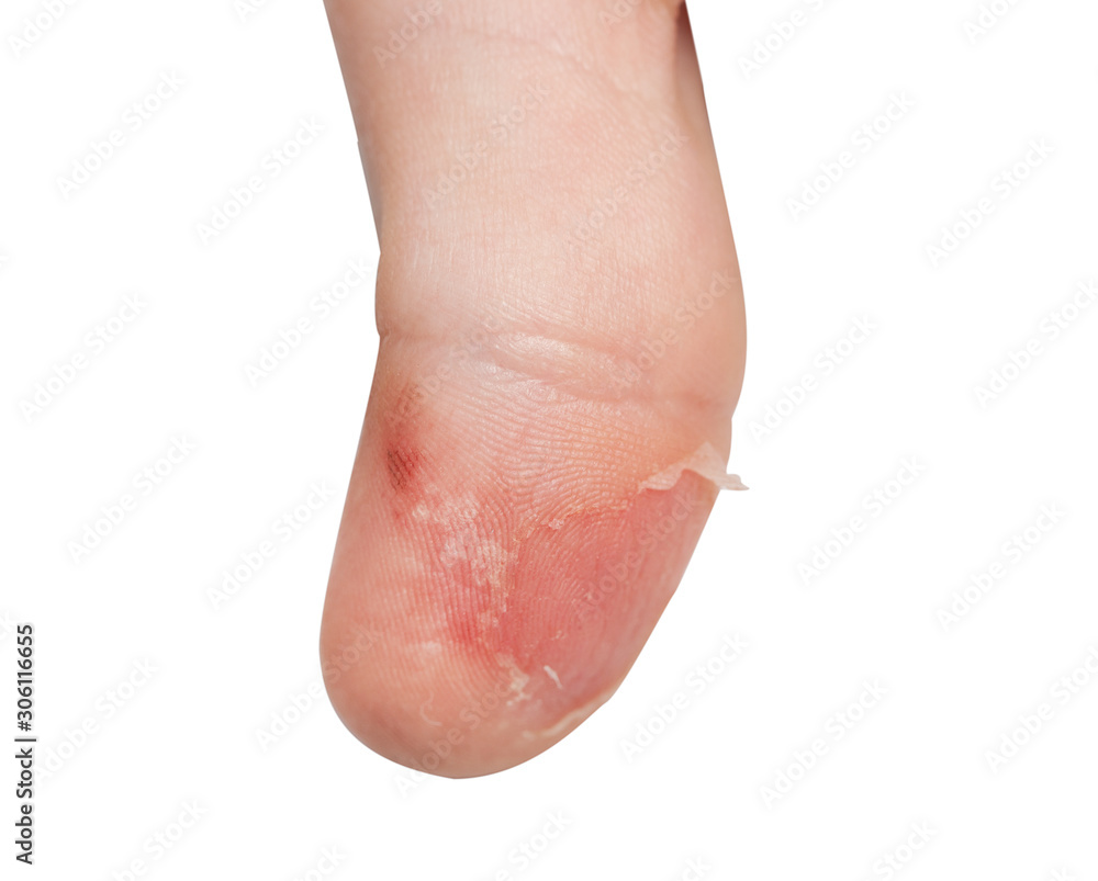The thumb of a child with scarlet fever. The initial stage of exfoliation of the skin The thumb of a child with scarlet fever. The initial stage of exfoliation of the skin