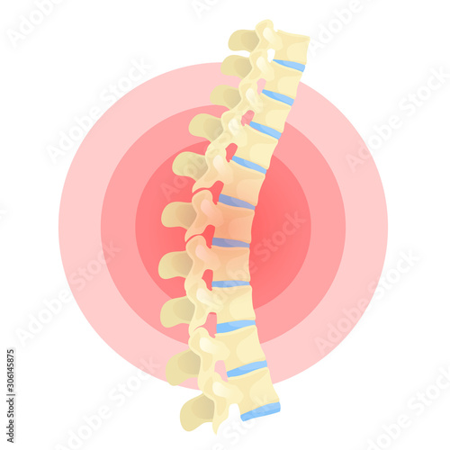 Spine deformation flat vector color isolated illustration