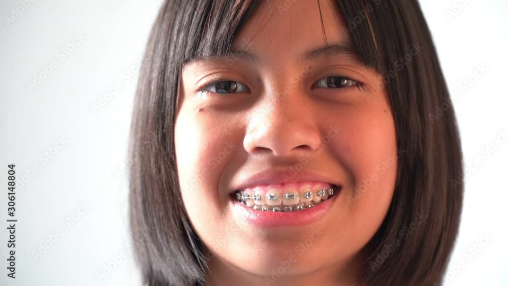 Closeup of Girl with Dental Brace Smiling and Looking to Camera Closeup of Girl with Dental Brace Smiling and Looking to Camera