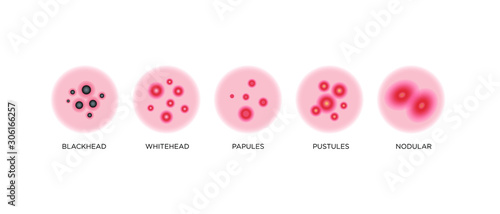Acne types, skin pimples blackheads and face comedones. Vector icons of skin acne pimples, cosmetology and skincare problems
