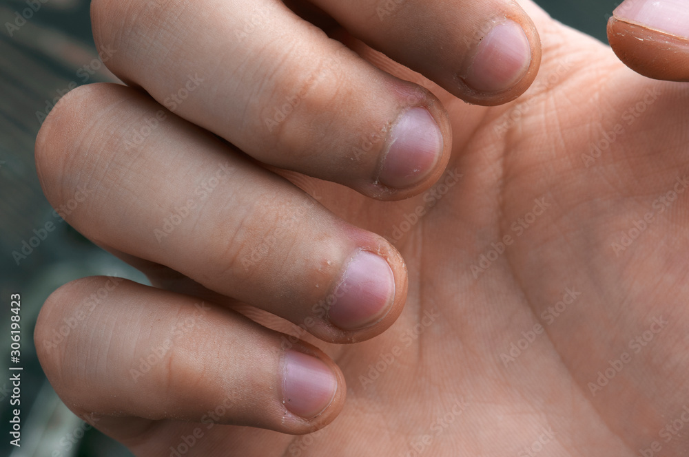 Damaged skin on the finger, burrs, macro Damaged skin on the finger, burrs, macro