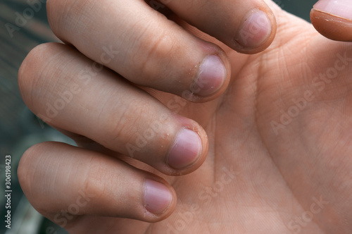 Damaged skin on the finger, burrs, macro