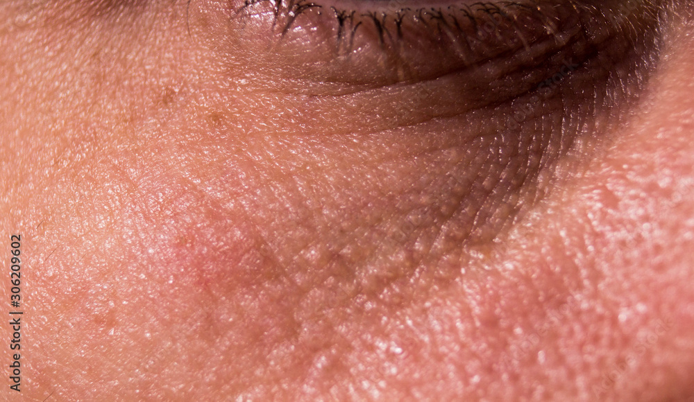 Fototapeta premium Skin aging under the eye. Eyelids in wrinkled wrinkles. Near