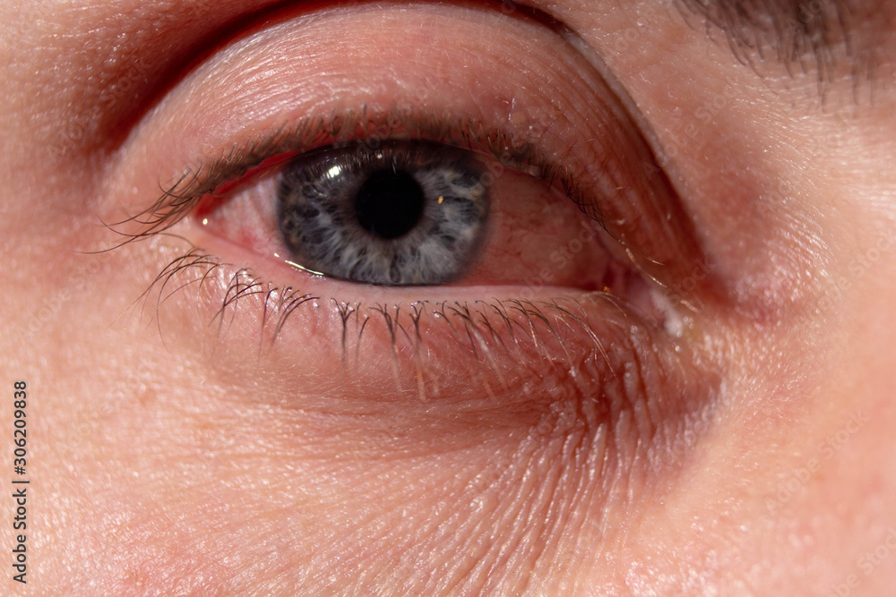 Pus arises from an infected eye. Near Pus arises from an infected eye. Near