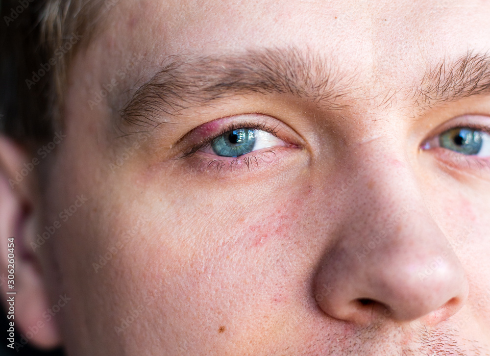 Selective focus on swollen and painful red upper eye lid with onset of stye infection due to clogged oil gland and staphylococcal bacteria. Close up right upper eyelid abscess. Selective focus on swollen and painful red upper eye lid with onset of stye infection due to clogged oil gland and staphylococcal bacteria. Close up right upper eyelid abscess.