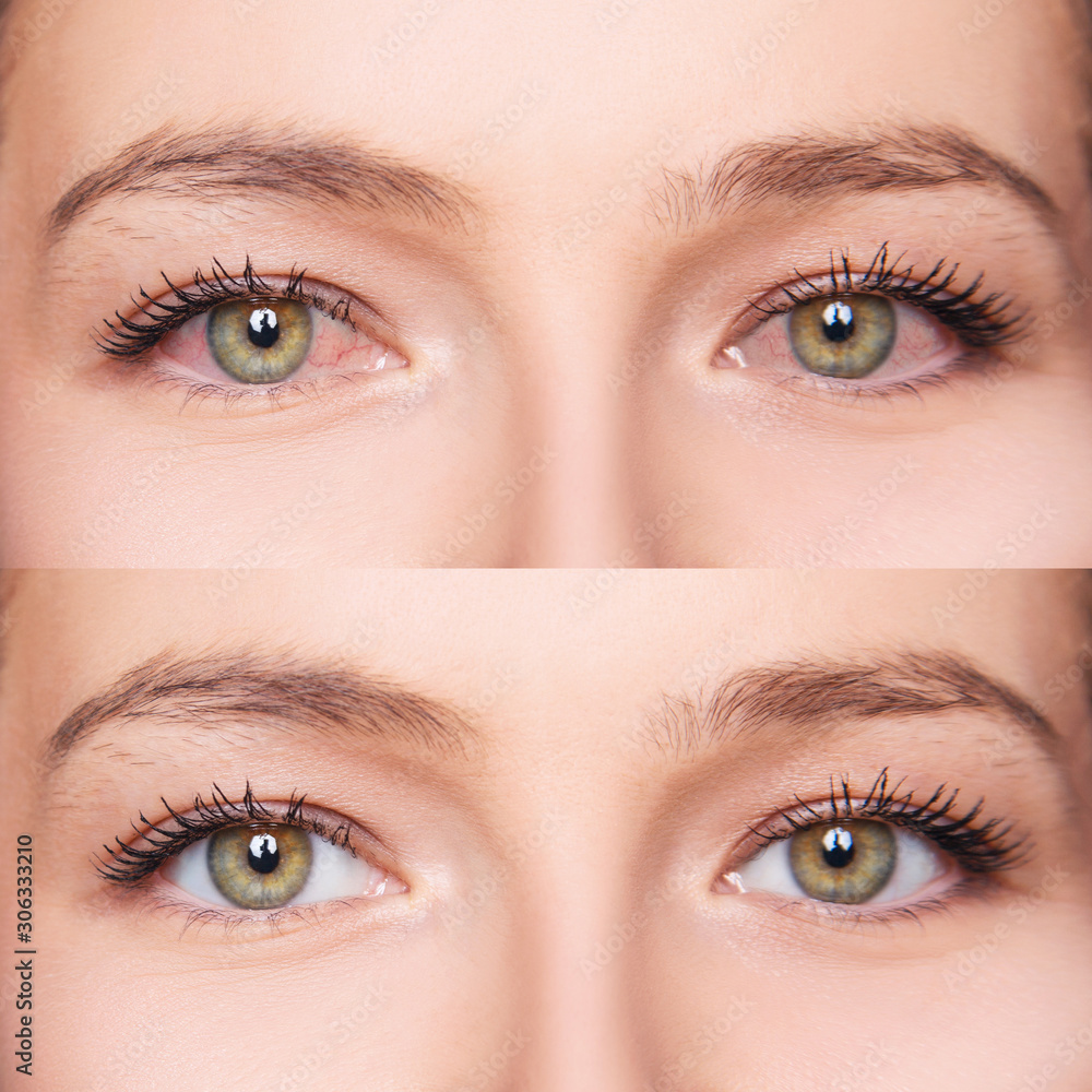 Irritated female eyes with redness before and after treatment. Irritated female eyes with redness before and after treatment.