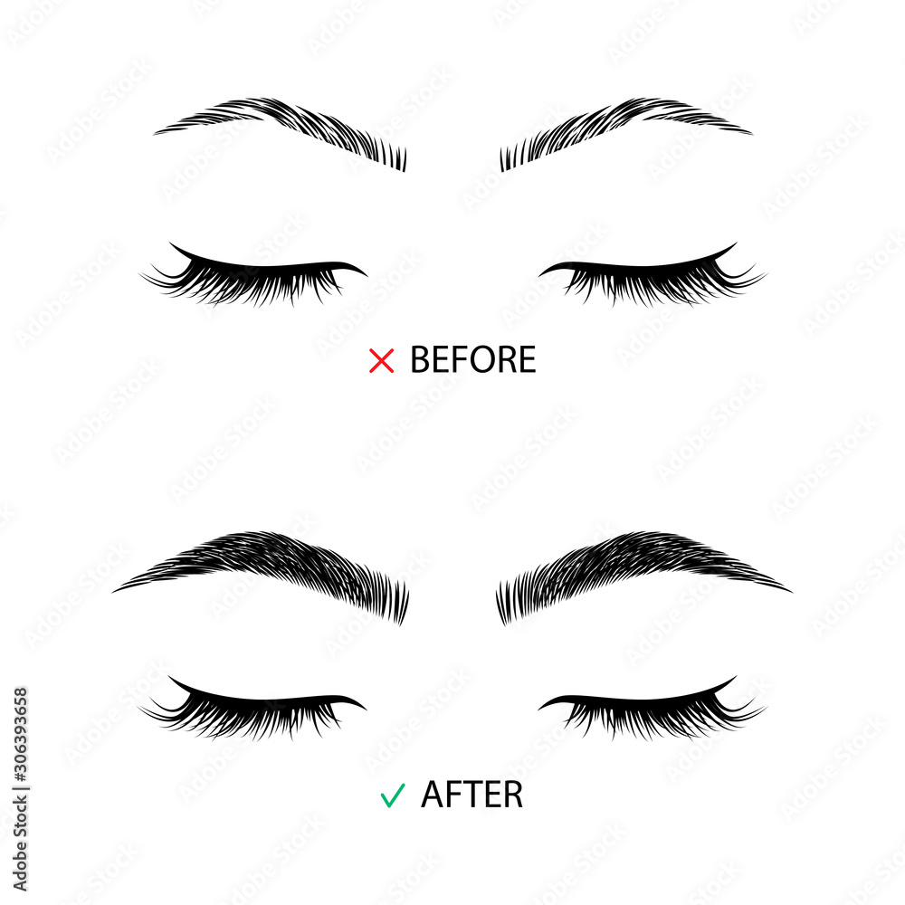 Brow correction before and after illustration Brow correction before and after illustration
