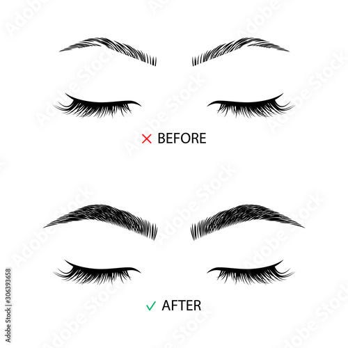 Brow correction before and after illustration