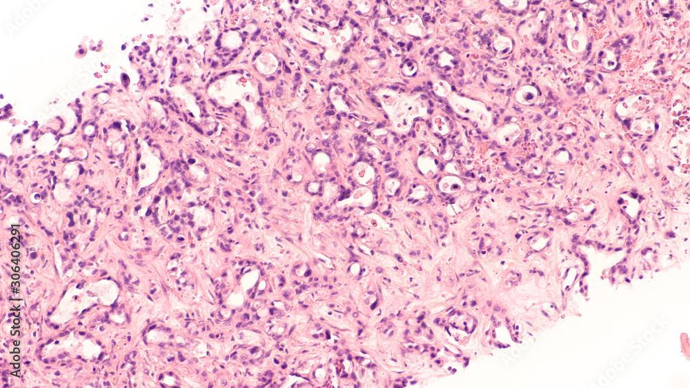 Microscopic image of core biopsy of liver showing metastatic cancer of the pancreas (pancreatic adenocarcinoma). Microscopic image of core biopsy of liver showing metastatic cancer of the pancreas (pancreatic adenocarcinoma).