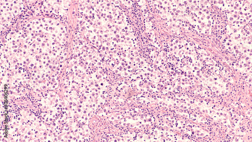 Testicular Cancer: Photomicrograph of seminoma, a malignant germ cell tumor of the testis (testicle).  It has a survival rate of 95% photo