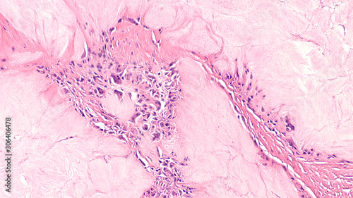 Microscopic image (photomicrograph) of a surgical specimen showing a gouty tophus, resulting from an accumulation of uric acid crystals, from a gout patient with high blood levels of  uric acid. photo