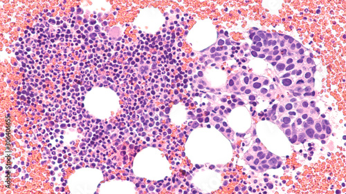 Foto Photomicrograph of a bone marrow biopsy showing involvement by metastatic breast cancer (invasive ductal carcinoma)