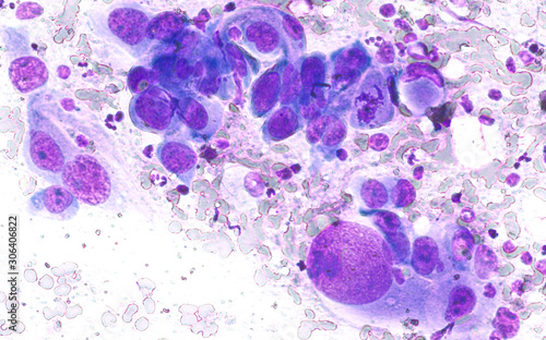 Phogomicrograph of fine needle aspiration (FNA) cytology of a pulmonary (lung) nodule showing adenocarcinoma, a type of non small cell carcinoma.
