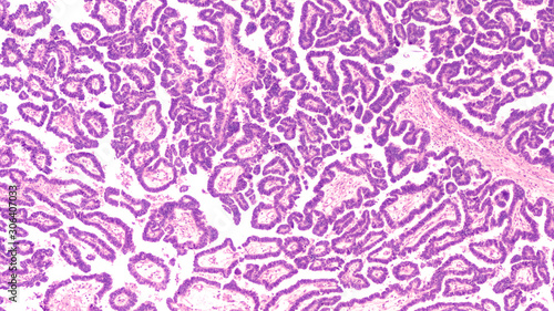 Ovarian Cancer Awareness: Micrograph of a serous papillary carcinoma (adenocarcinoma) of ovary, with intricately branching papillae. This tumor has a poor prognosis, as early detection is problematic. photo