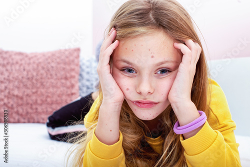 Girl with pox  sits at home