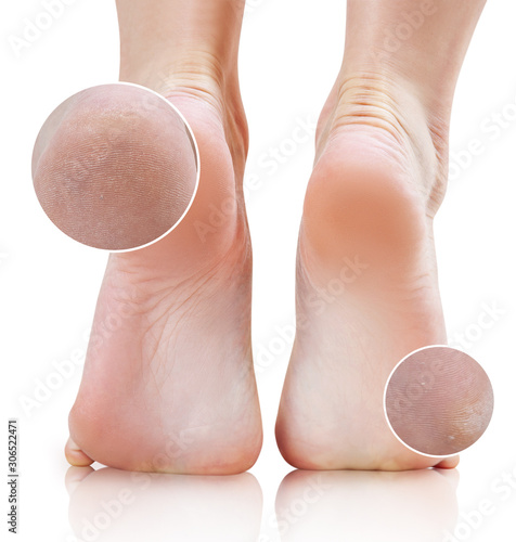 Zoom circles shows callus treatment result on feet. photo