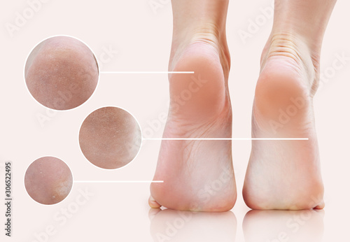 Zoom circles shows callus treatment result on feet. photo