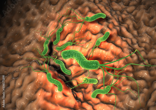 Gastritis, helicobacter pylori in stomach, medically accurate 3D illustration. photo