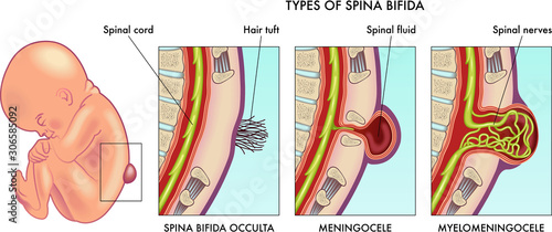 Medical illustration of infant spina bifida with annotation.