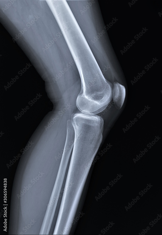 normal radiography of the knee joint in lateral projection, medical diagnostics, traumatology and orthopedics normal radiography of the knee joint in lateral projection, medical diagnostics, traumatology and orthopedics
