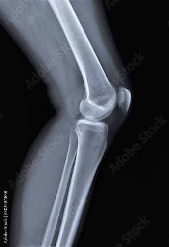 normal radiography of the knee joint in lateral projection, medical diagnostics, traumatology and orthopedics