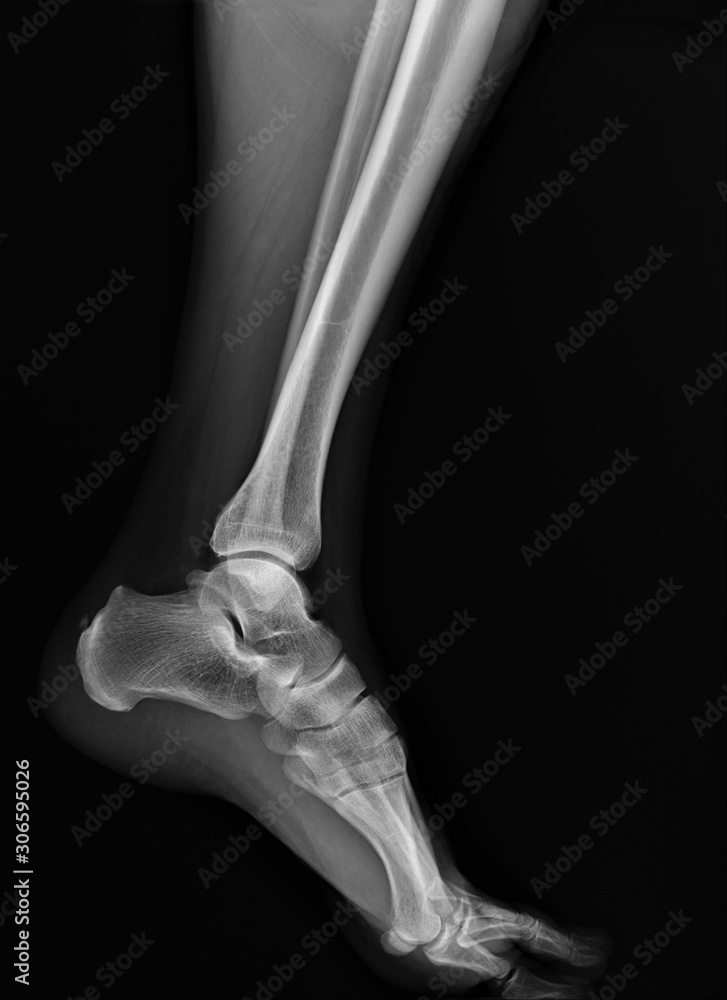 normal radiograph of the ankle joint Stock Photo | Adobe Stock