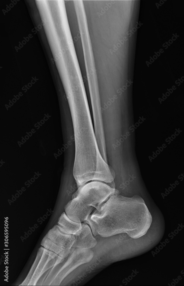 Stock Ankle: Normal Anatomy — Illustrated Verdict