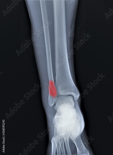 radiograph of the ankle joint with a fracture of the outer ankle without displacement  traumatology  medical diagnostics