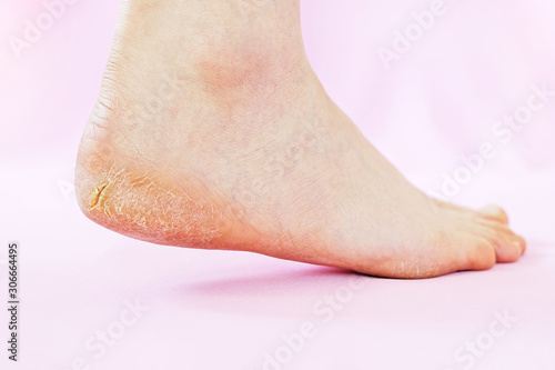 Legs female with dry cracked skin on a pink background.