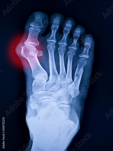  X-ray foot and arthritis at metatarsophalangeal joint (Big toe area)