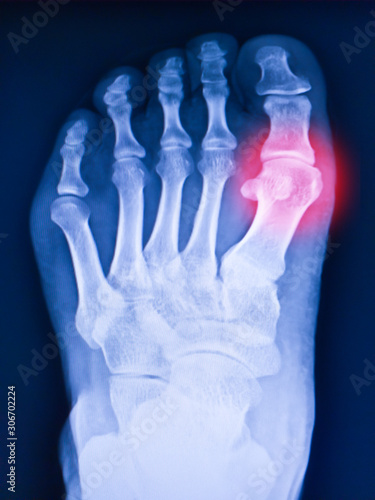 X-ray foot and arthritis at metatarsophalangeal joint (Big toe area) photo