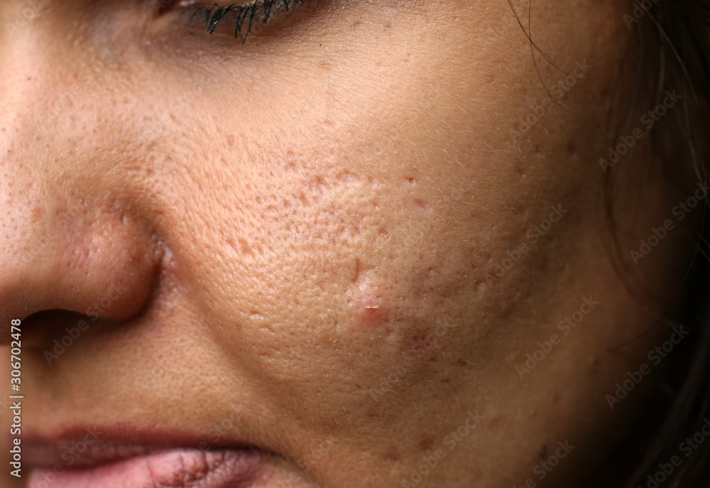 Inflamed skin on the face. Acne. Pimples on the skin. Scars and peeling. Inflamed skin on the face. Acne. Pimples on the skin. Scars and peeling.