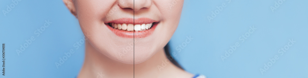 Smiling woman with before and after teeth whitening, Photo deveded two parts. Blue background.