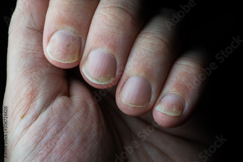 Fotografie Psoriasis is an autoimmune disease that affects the nail and skin