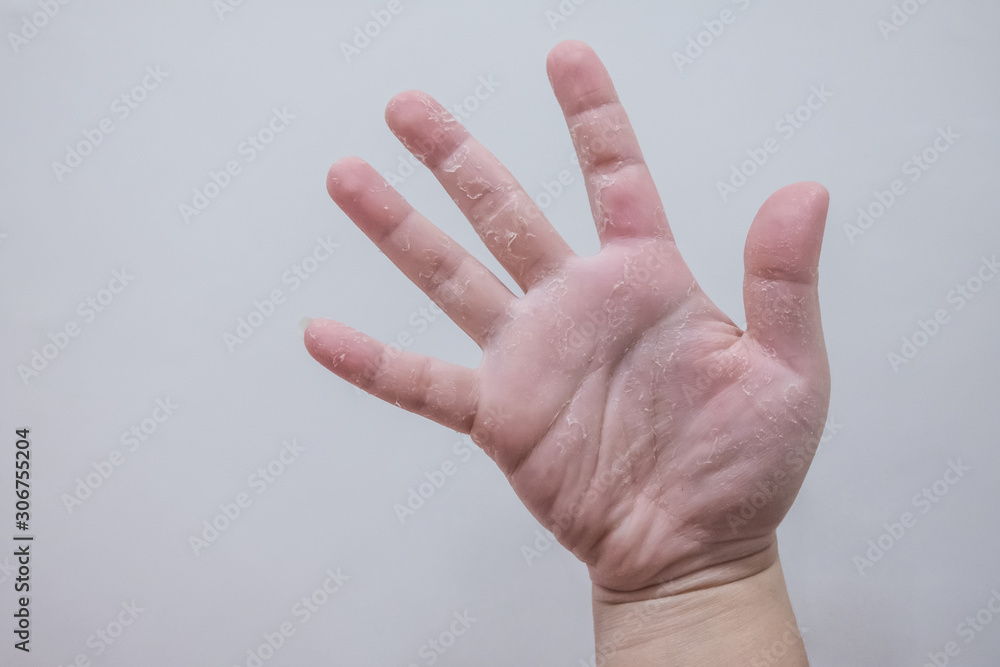 This image shows hands peeling caused by vitamin A deficiency. Stock