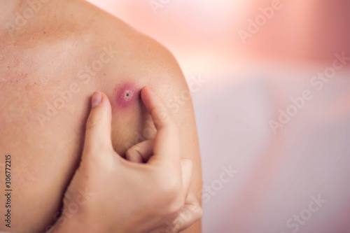 Canvas Print Woman tries to crush boil on her shoulder