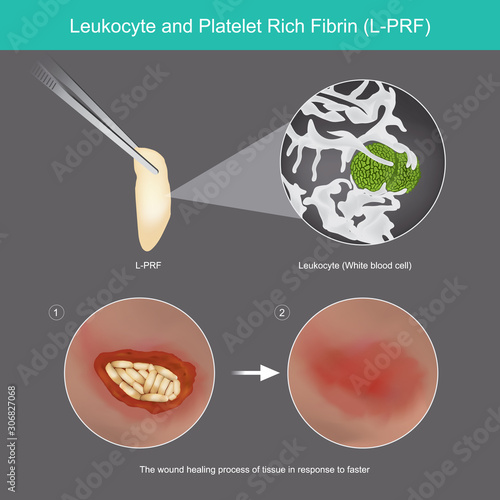 Leukocyte and Platelet Rich Fibrin. Illustration wound healing process of skin tissue by use  Leukocyte from platelet rich fibrin L-PRF..