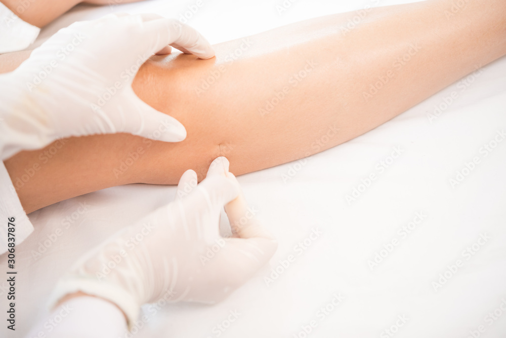 Therapy of female leg with pricking acupuncture needles Therapy of female leg with pricking acupuncture needles