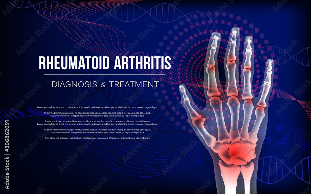 Rheumatoid arthritis osteoarthritis banner inflammation joints of bones of hand. - obrazy, fototapety, plakaty 