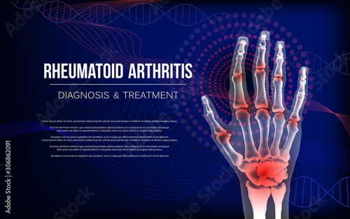 Rheumatoid arthritis osteoarthritis banner inflammation joints of bones of hand. photo