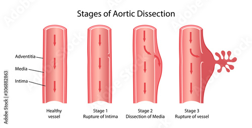Stages of aortic dissection: rupture Intima, dissection Media, rupture vessel. Image of healthy and damaged aorta. Vector illustration in flat style with main description isolated on white background photo