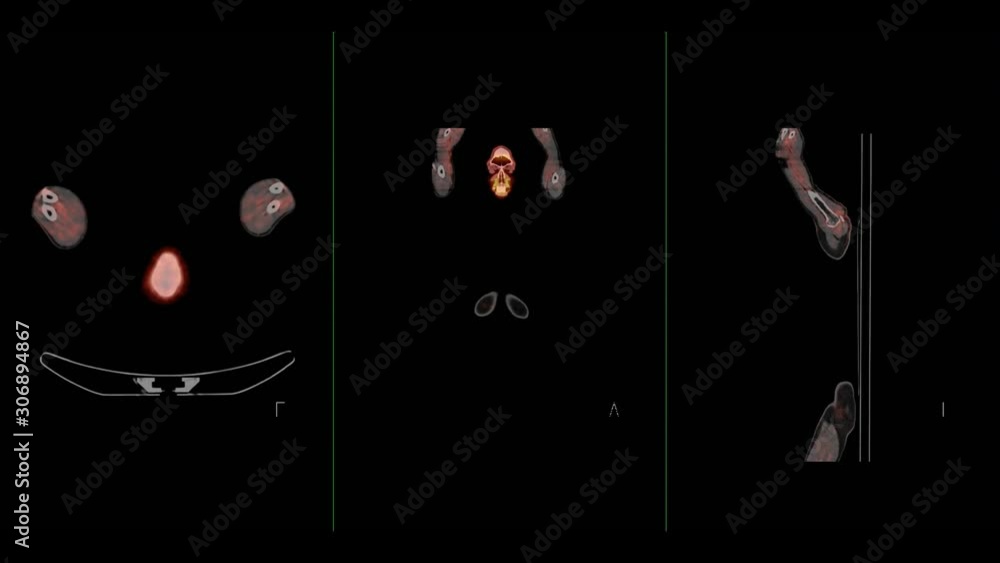 Compare of PET CT Scan fusion image of Whole human body axial , coronal ...