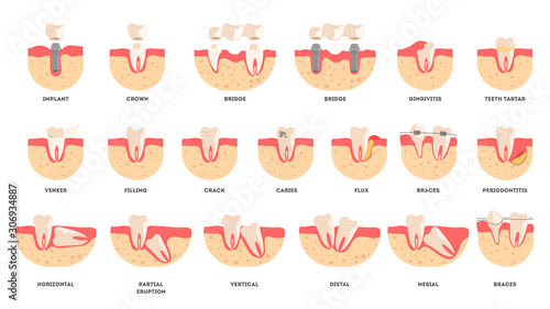 Set of human teeth in diffrent condition. Dental health and disease concept.
